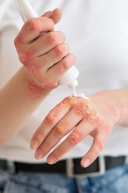 Overview of Wynzora Cream for Psoriasis Treatment